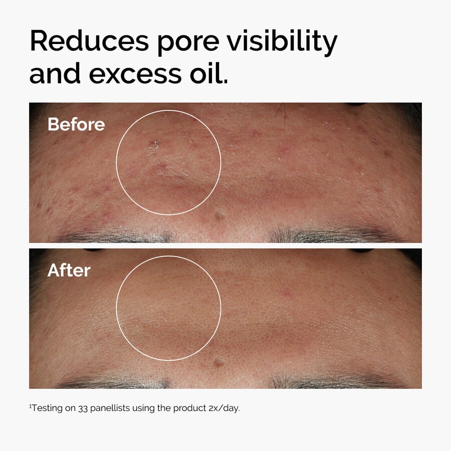 niacinamide-10-zinc-1-c9 ord-niacinamide-zinc-blemish-serum-before-after-pores.jpg