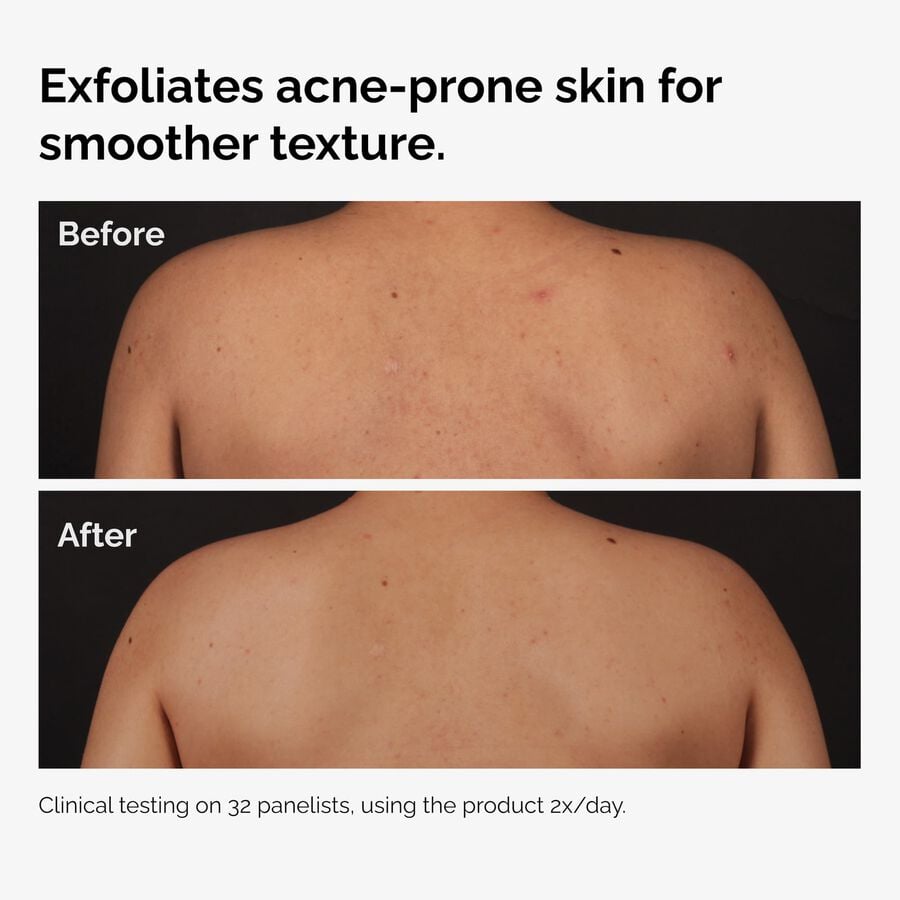 the-body-care-collection-e9 ord-salicylic-acid-body-serum-before-after-graphic-NA.jpg